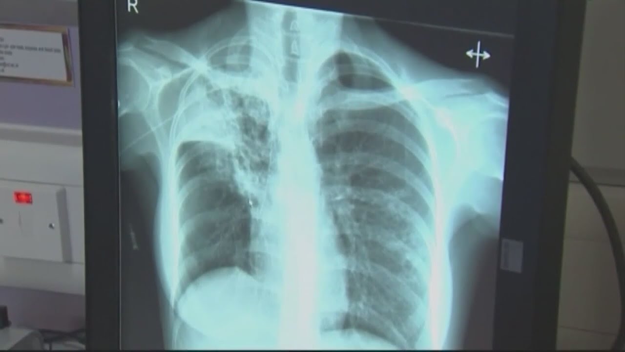 Kansas officials say risk is low after tubercolosis outbreak